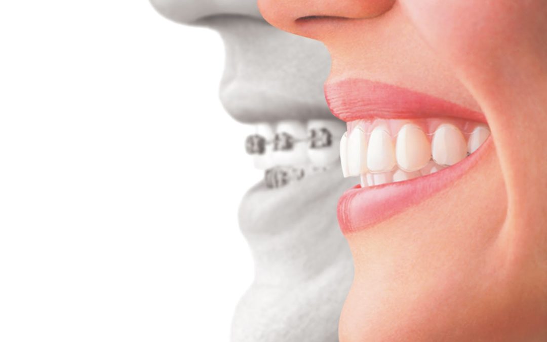 Ask Your Dentist: What’s the difference between Invisalign and Metal Braces?