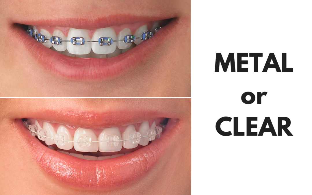 Ask Your North Houston and East Texas Dentist: Should I Get Metal or Clear Braces?