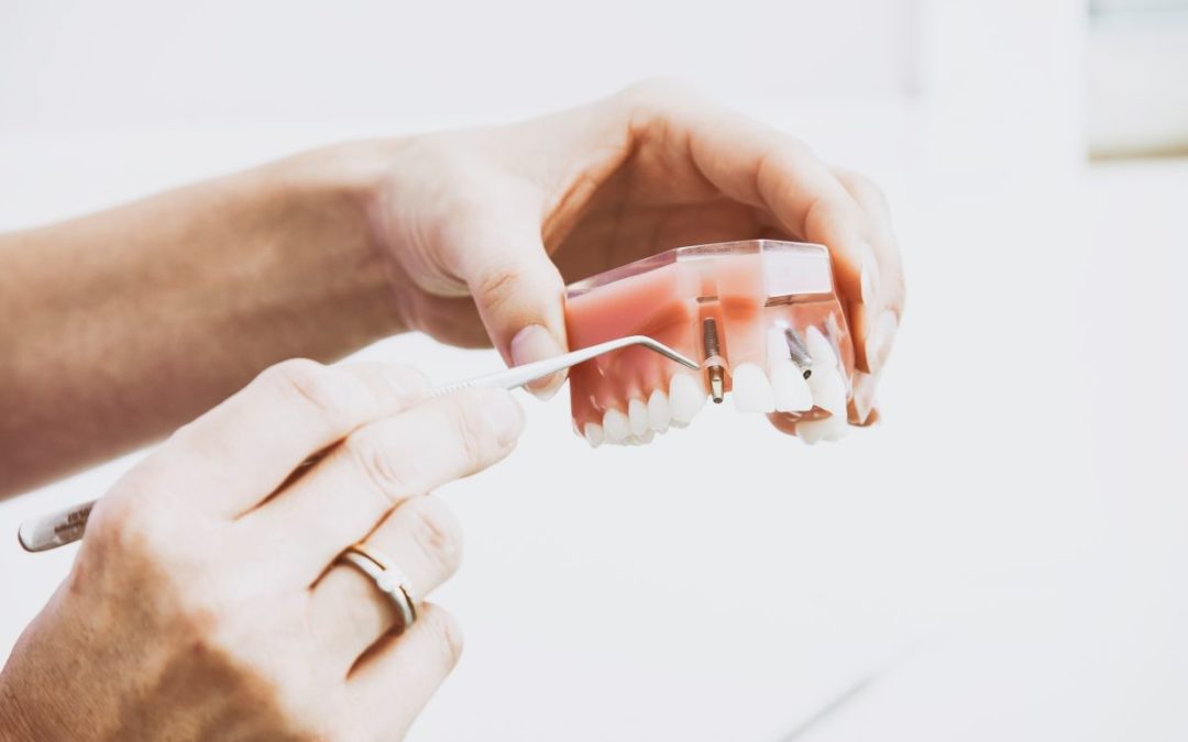 Dental Implant Recovery Facts You Need to Know
