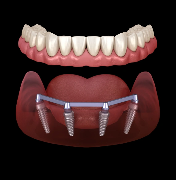 All-on-4 Dental Implants
