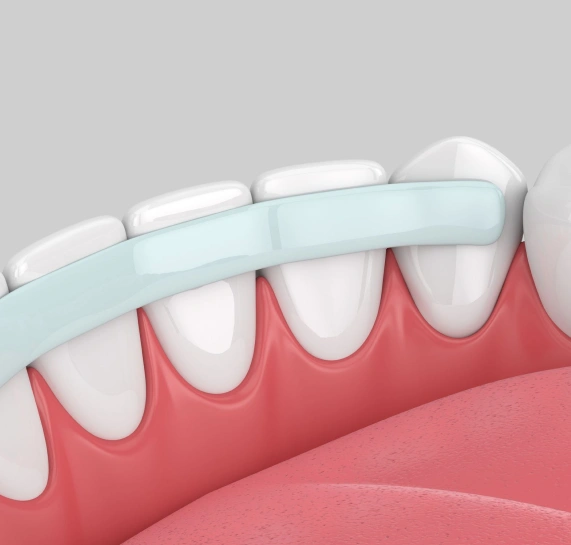 Cosmetic Bonding