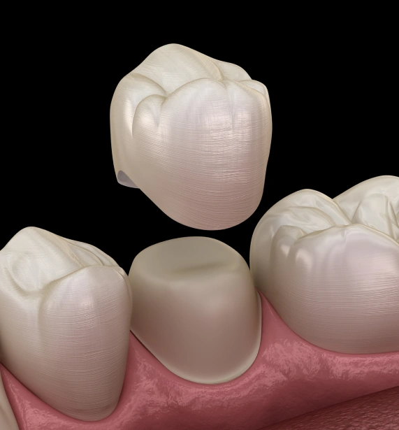 Dental Crowns