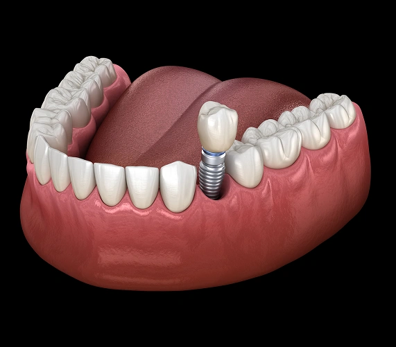 Dental Implants