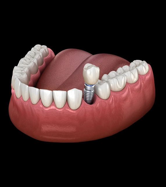 Dental Implants
