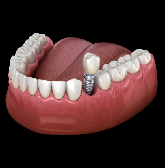Dental Implants