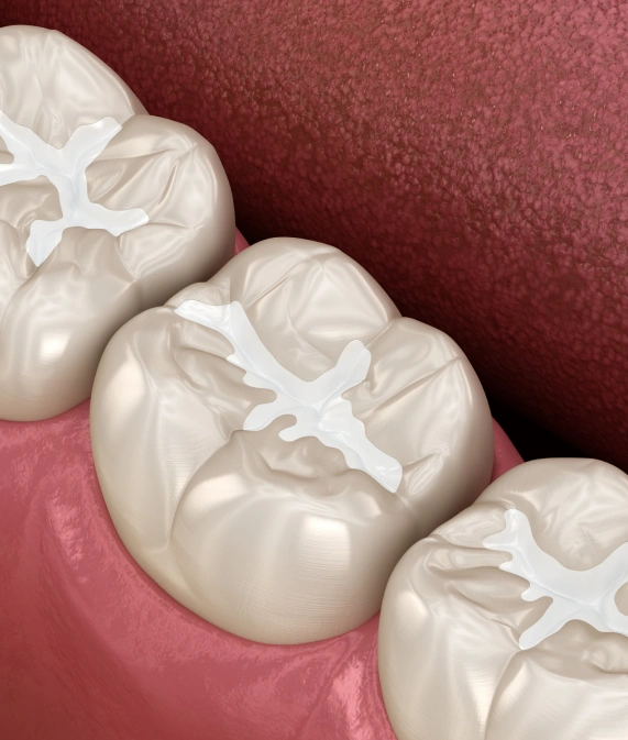 Dental Sealants