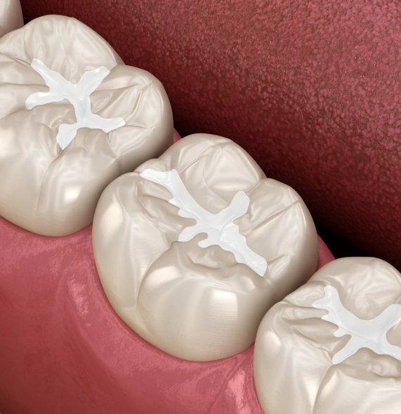 Dental Sealants