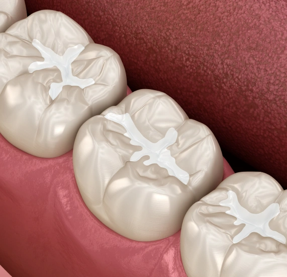 Dental Sealants