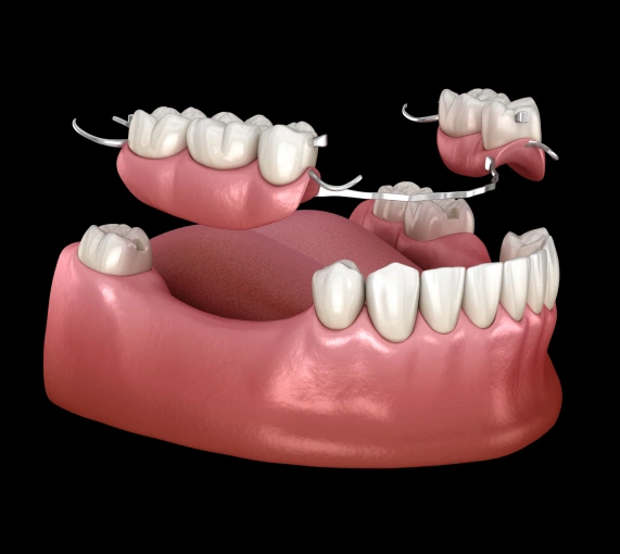 Dentures & Bridges