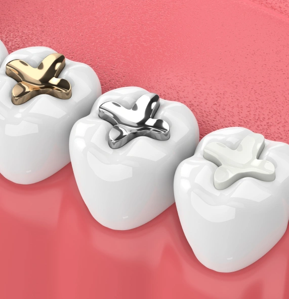 Dental Fillings