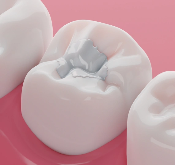 Dental Fillings