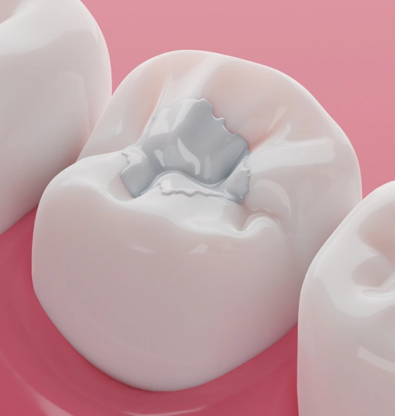 Dental Fillings
