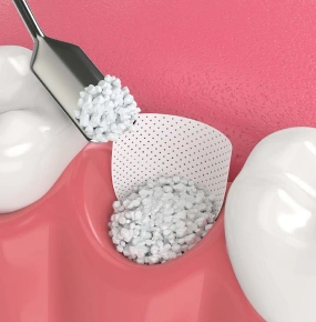 Site Preparation and Bone Grafting