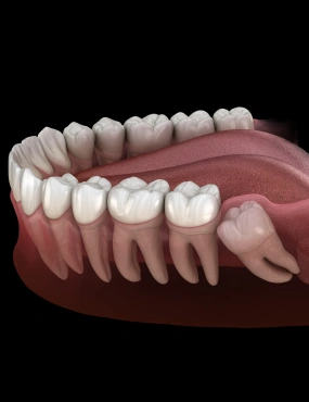 Wisdom Teeth Removal