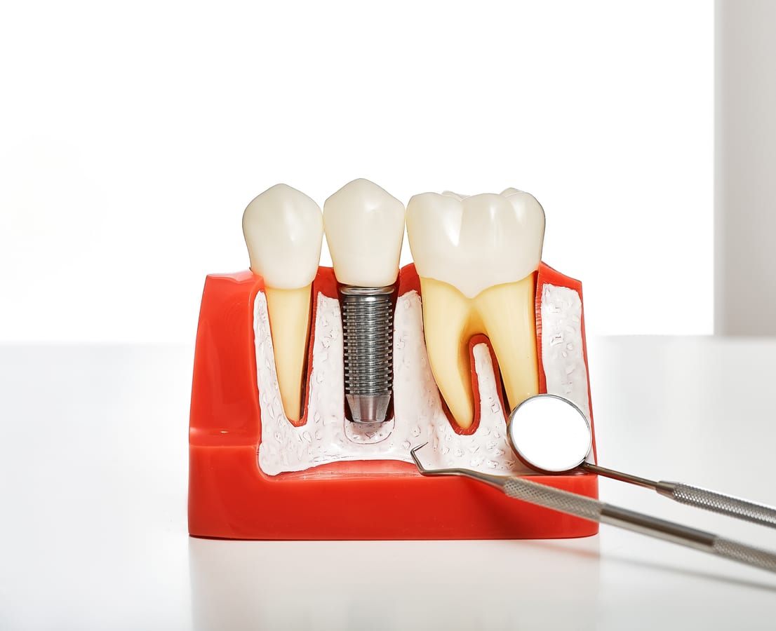All-On-4 Implants in Bryan